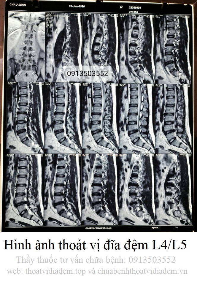 Hình ảnh thoát vị đĩa đệm 